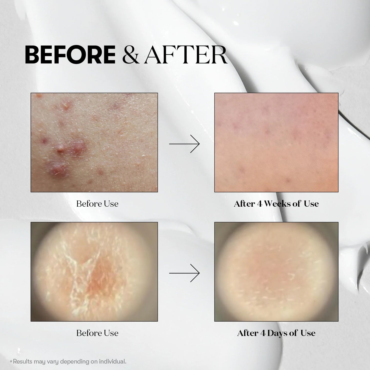 Before and after skin treatment results on a white background