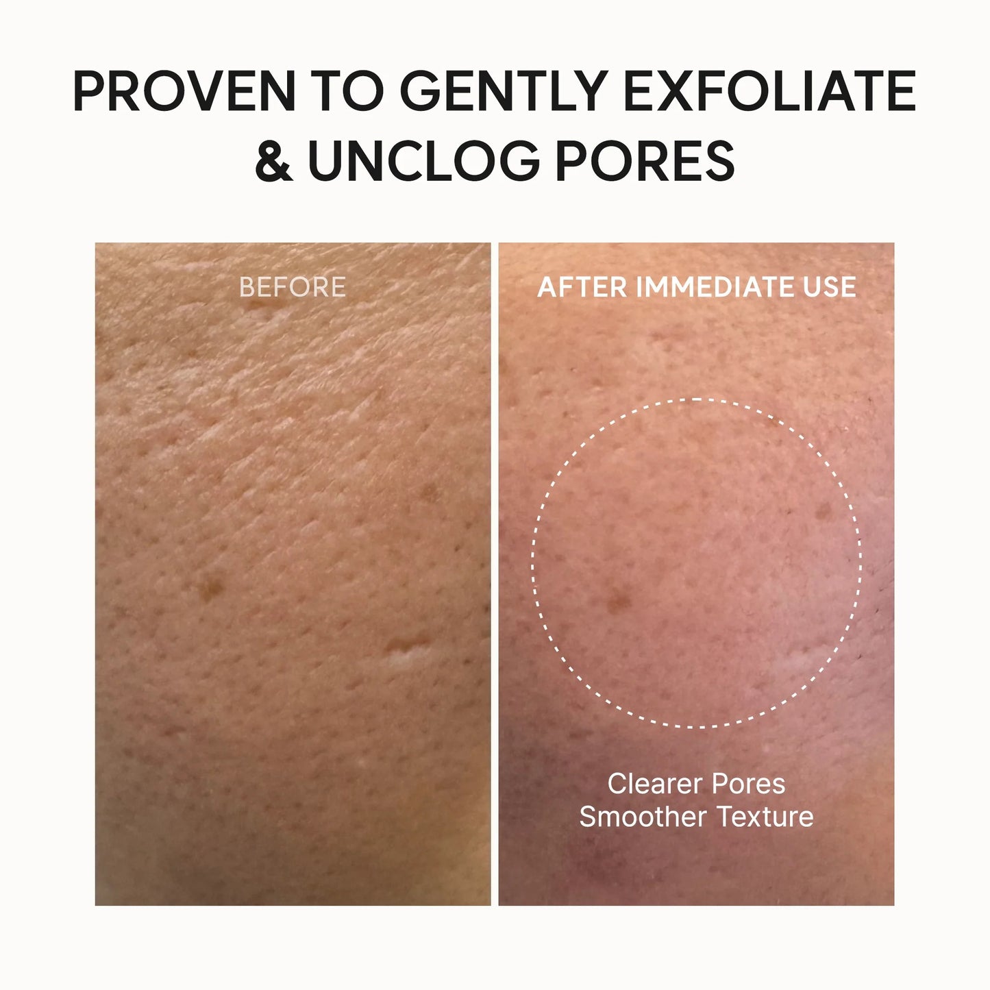 Before and after skin treatment showing clearer pores and smoother texture.
