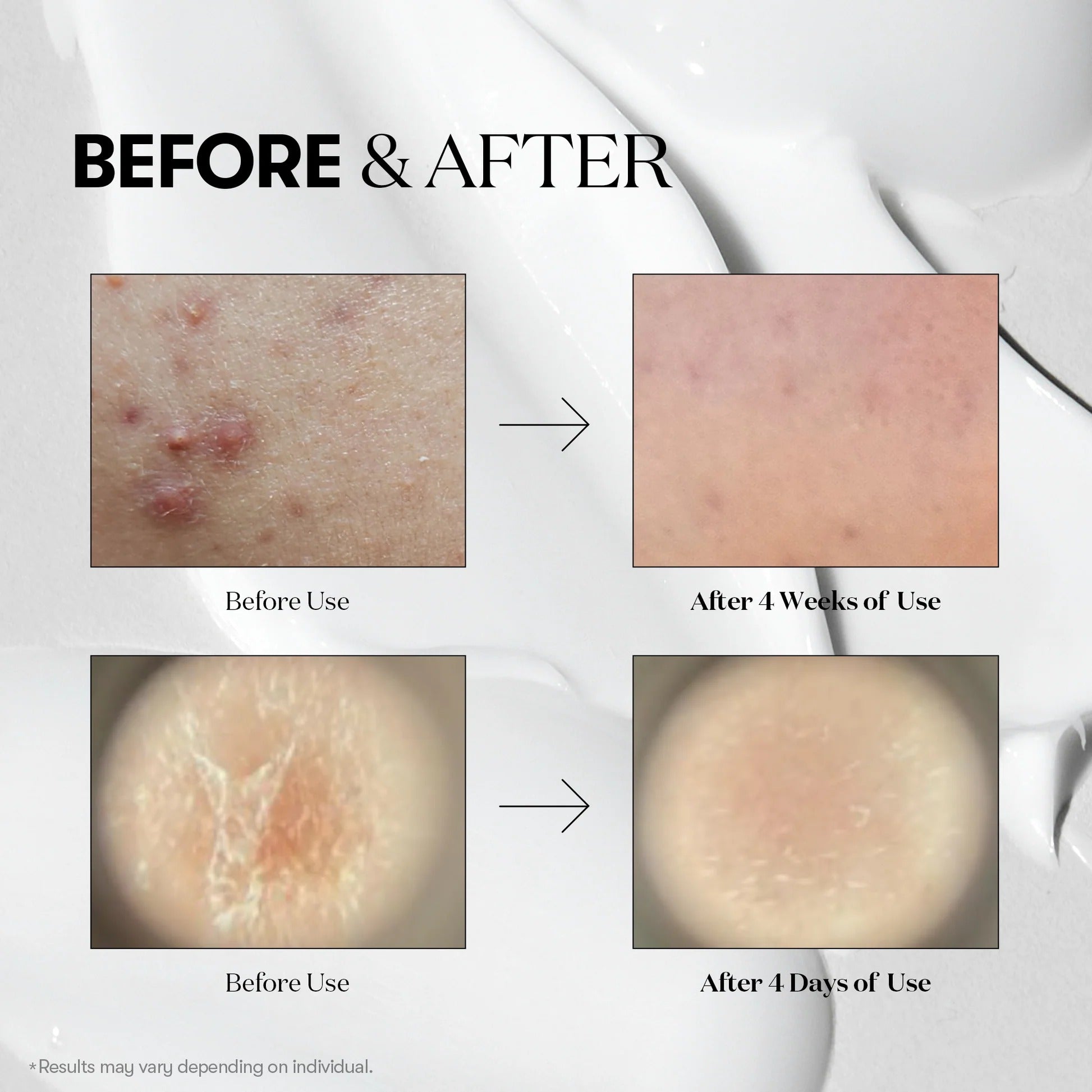 Before and after skin treatment results on a white background